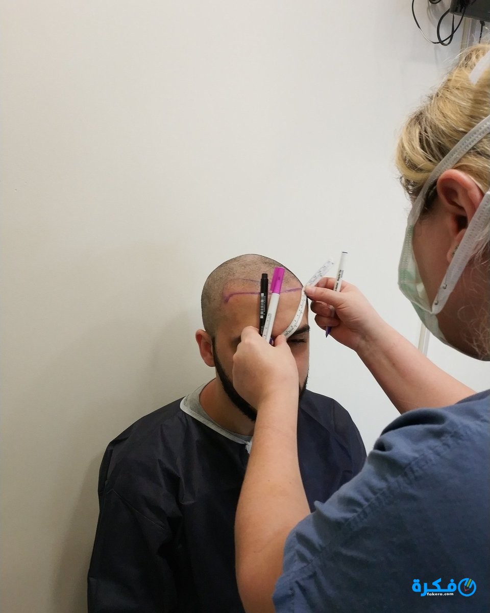 أسعار زراعة الشعر بالليزر في مصر 2025 1 أسعار زراعة الشعر بالليزر في مصر 2019
