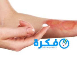 كريم بينتابورن Pentaburn لعلاج الحروق والجروح 1 burn skin cream Custom