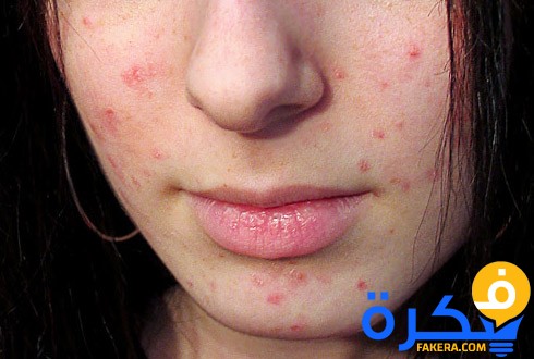 شرح خطوات علاج التهابات الوجه 1 9e82a26933c11dd1