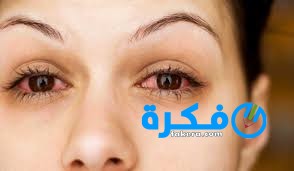 طرق علاج التهابات العين Ophthalmitis 1 Ophthalmitis