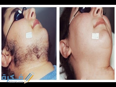 المنام بظهور شعر في الوجه 1 hqdefault 7