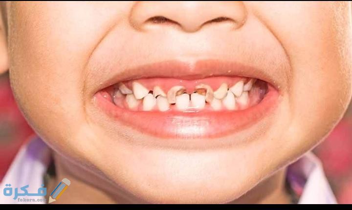 علاج تسوس الاسنان عند الاطفال 1 IMG 20200525 WA0013