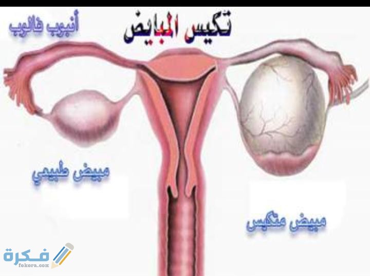 هل تكيس المبايض البسيط يمنع الحمل 1 IMG 20200525 WA0029