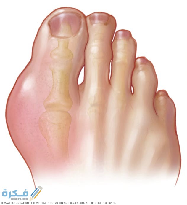 أعراض مرض النقرس 1 IMG 20200526 WA0000