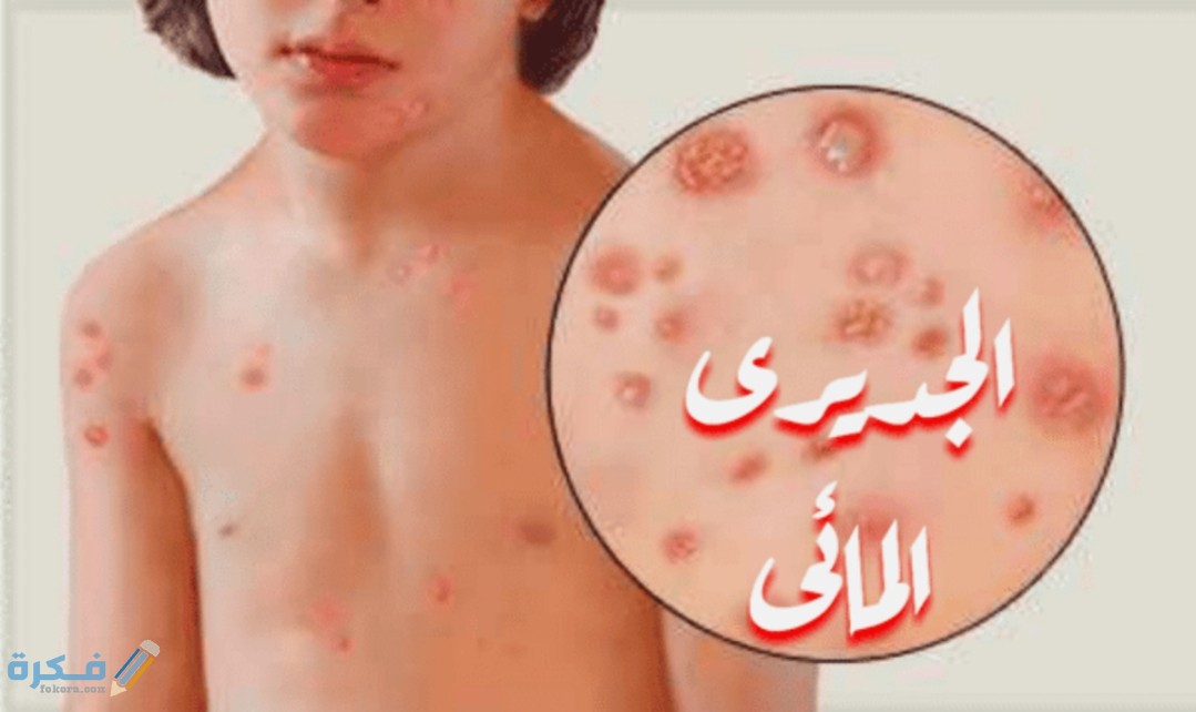 متى يشفى مريض الجدري ؟ 1 IMG ٢٠٢٠٠٥١٨ ١٥٣٣١٨