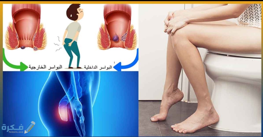 علاج مرض البواسير 1 IMG ٢٠٢٠٠٥٢٣ ٠٩٤٩٣٦
