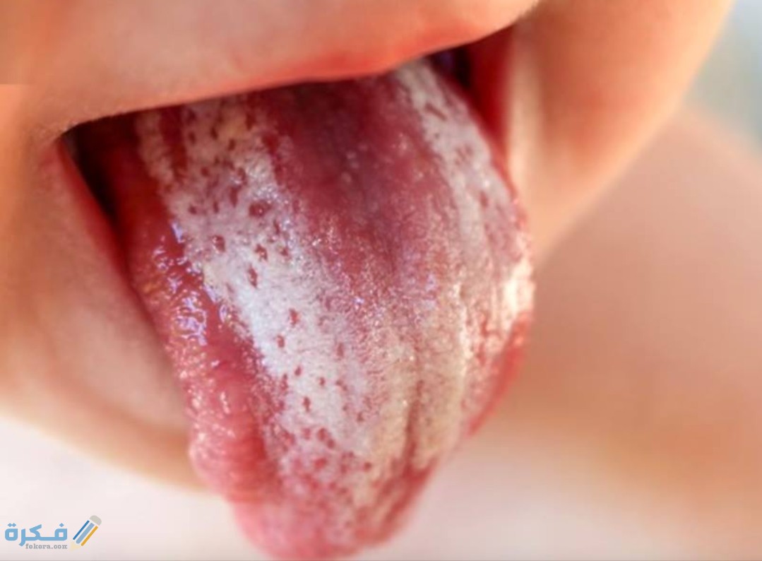 جل فطريات الفم للرضع 1 IMG ٢٠٢٠٠٥٢٧ ١٠٢٩٢٨