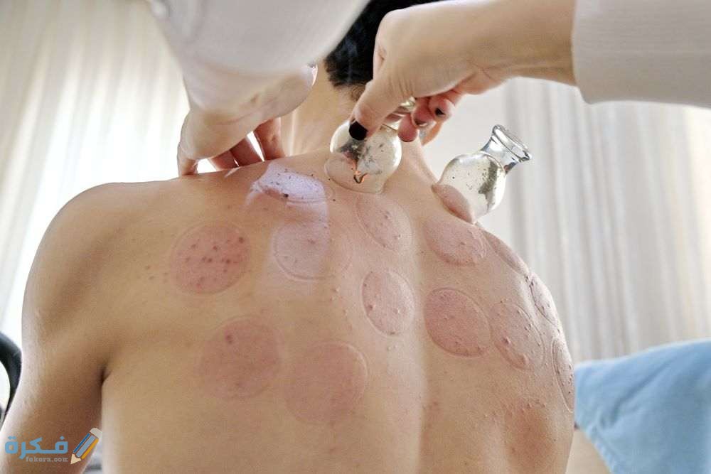 شروط فتح مركز حجامة في السعودية 1 الجافة