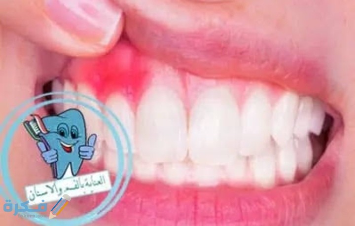 اسماء احسن الأدوية في علاج التهاب اللثة 2025 1 IMG ٢٠٢٠٠٧٢٥ ٠٠٣٥٠١