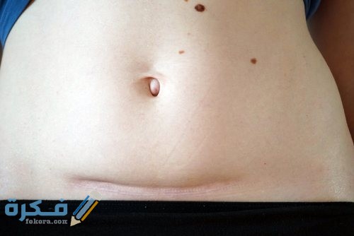 الخياطة التجميلية بعد الولادة القيصرية مباشرة 1 lsp شد البطن مع الولادة القيصرية 170718 113705