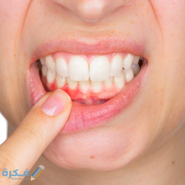 تفسير حلم خروج كتل دم من الفم لابن سيرين 1 how to treat bleeding gums 2