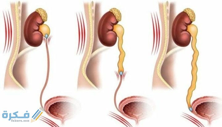 نزول الحصوة من الحالب 1 IMG ٢٠٢٠١٢٠١ ٠٢٢٠١٦