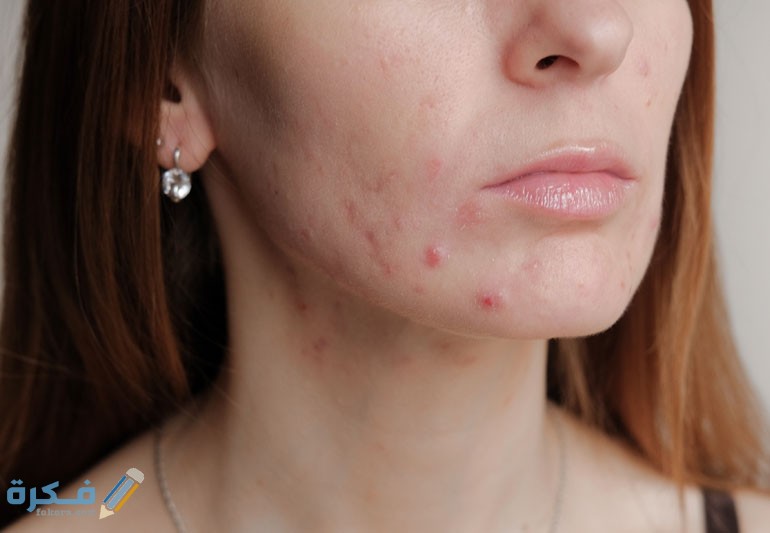 احسن 10 وصفات علاج حب الشباب جديدة 1 acneCare 1167910623 770x533 1