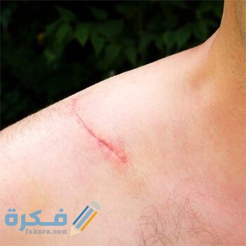 10 وصفات طبيعية لازالة آثار العمليات الجراحية و الخياطة 1 dog bite scarring img
