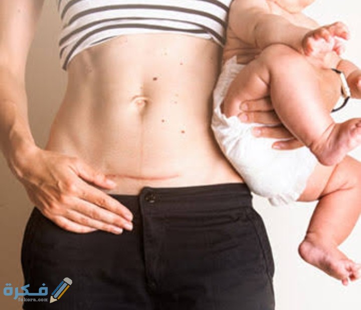 شرح خطوات علاج جرح العمليه القيصريه الملتهب 1 IMG ٢٠٢١٠٢١٣ ١٤٤٣٣٧