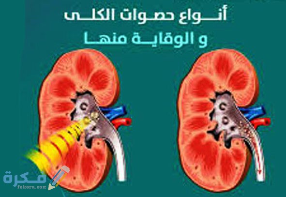 شرح خطوات علاج حصوة الكلى 6 ملم وشرح خطوات الوقاية منها 1 علاج حصوات الكلى الصغيرة