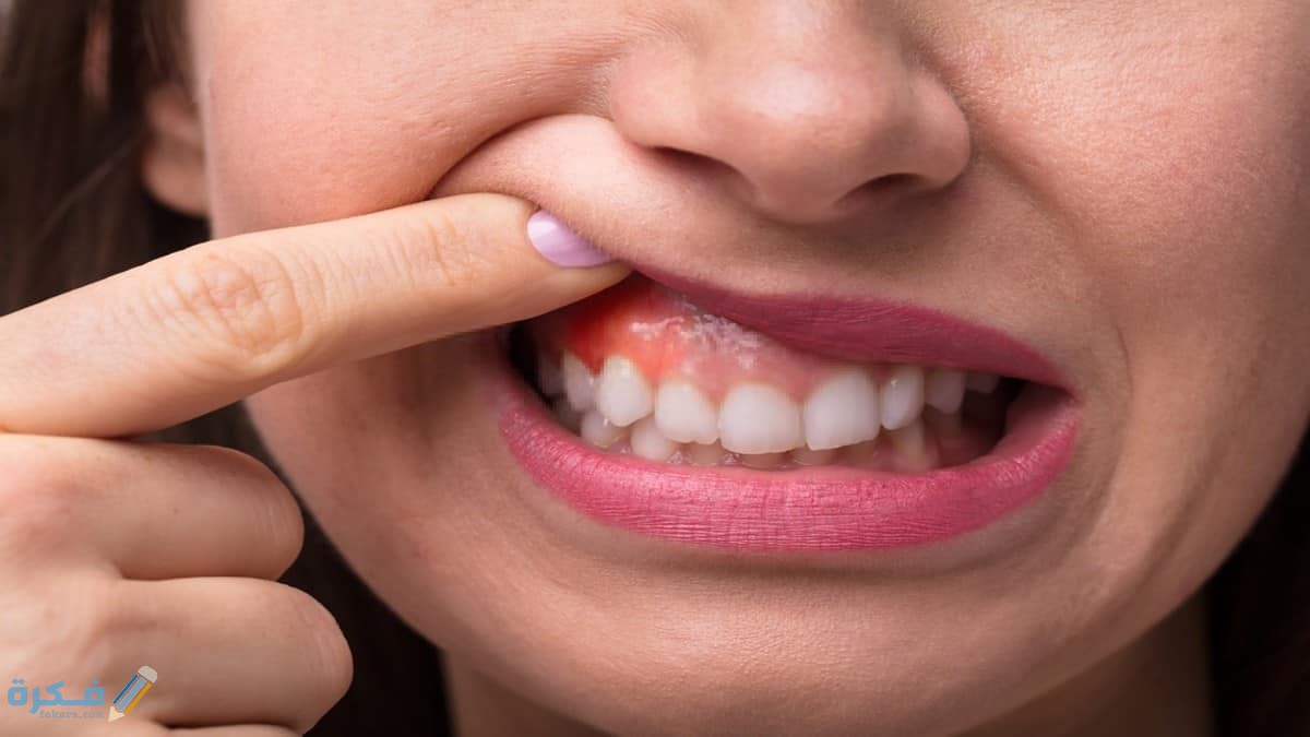 اسباب ظهور حبوب في اللثة 1 حبوب اللثة