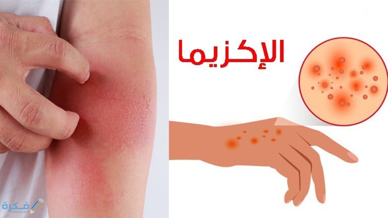 اسماء احسن كريم للإكزيما اليدين وأهم اسبابها 1 اسباب اكزيما اليدين وانواعها