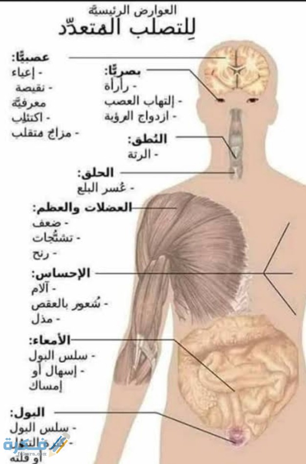ما هو مرض التصلب اللويحي 1 IMG ٢٠٢١٠٤٠٣ ٠١٠٢١٨