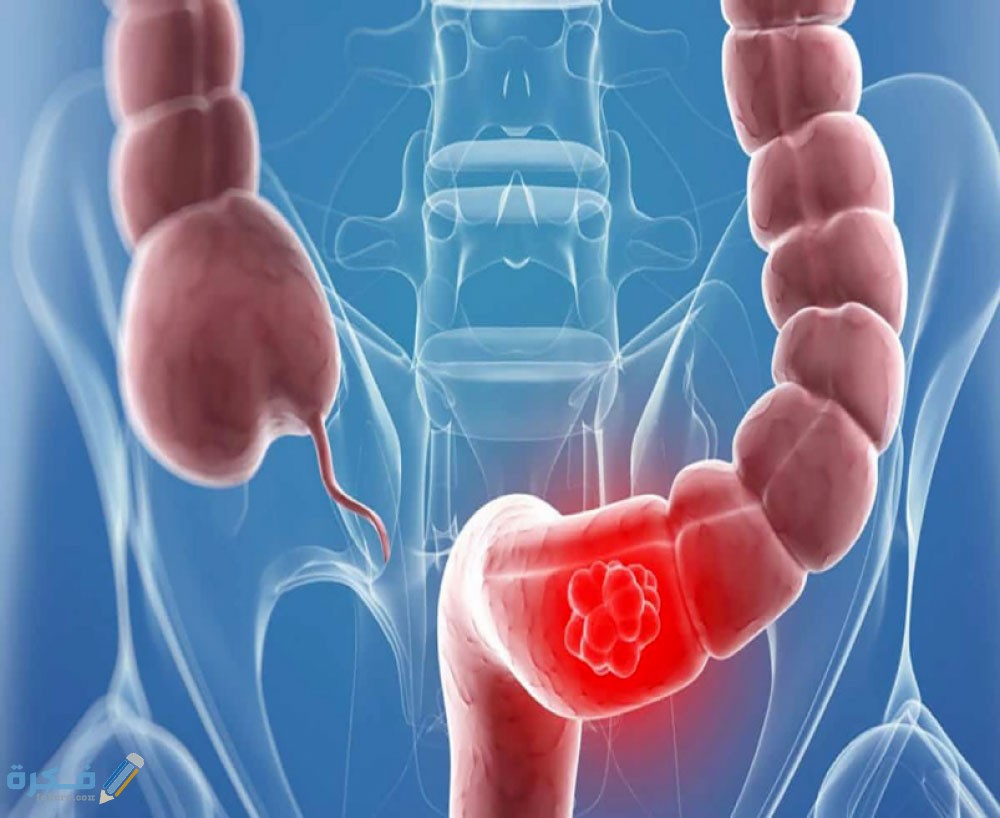 شرح خطوات التخلص من غازات القولون 1 علاج-غازات-البطن-