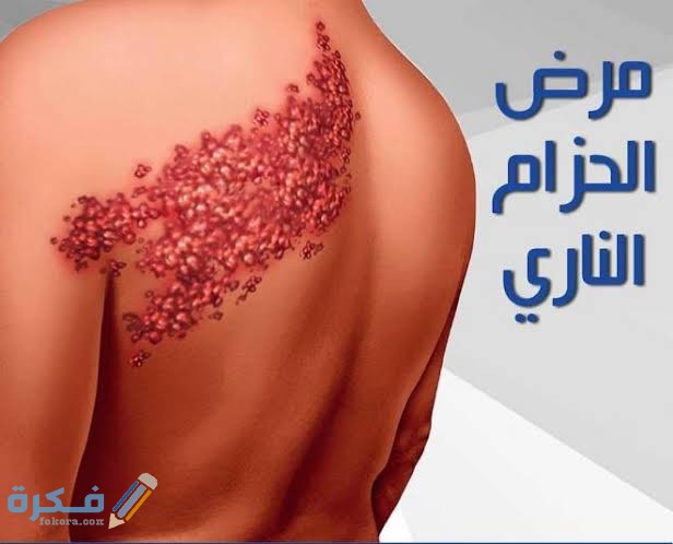 كيف تنتقل عدوى الحزام الناري 1 images 2021 04 03T205630.186