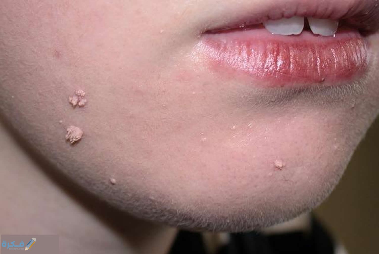 شرح خطوات التخلص من ثآليل الوجه 1 طريقة التخلص من ثاليل الوجه