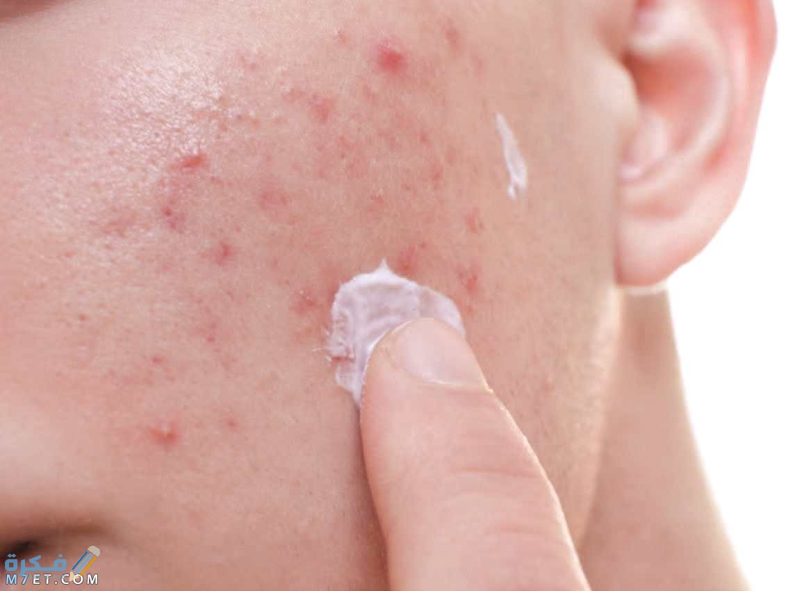 أهم 5 اسباب حب الشباب الملتهب وطرق علاجه 1 وسائل علاج حب الشباب