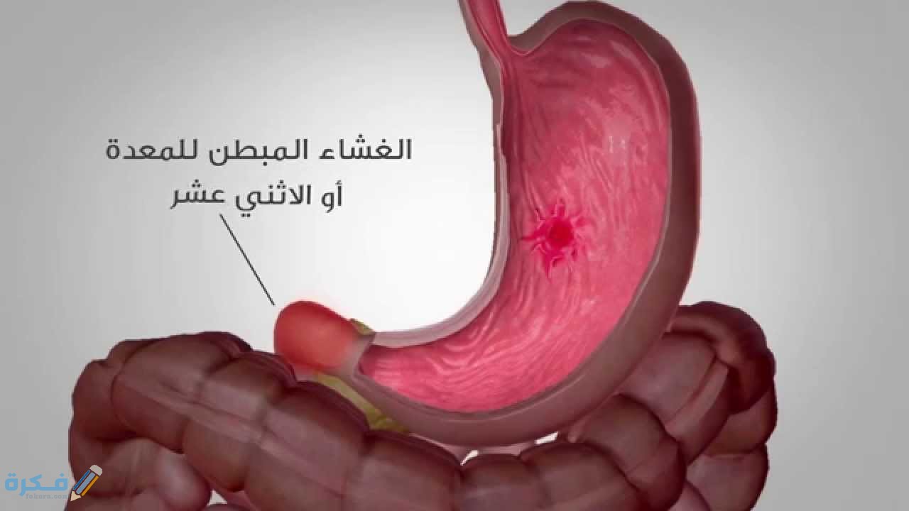 كم يستغرق علاج قرحة المعدة وطرق العلاج 1 2 6