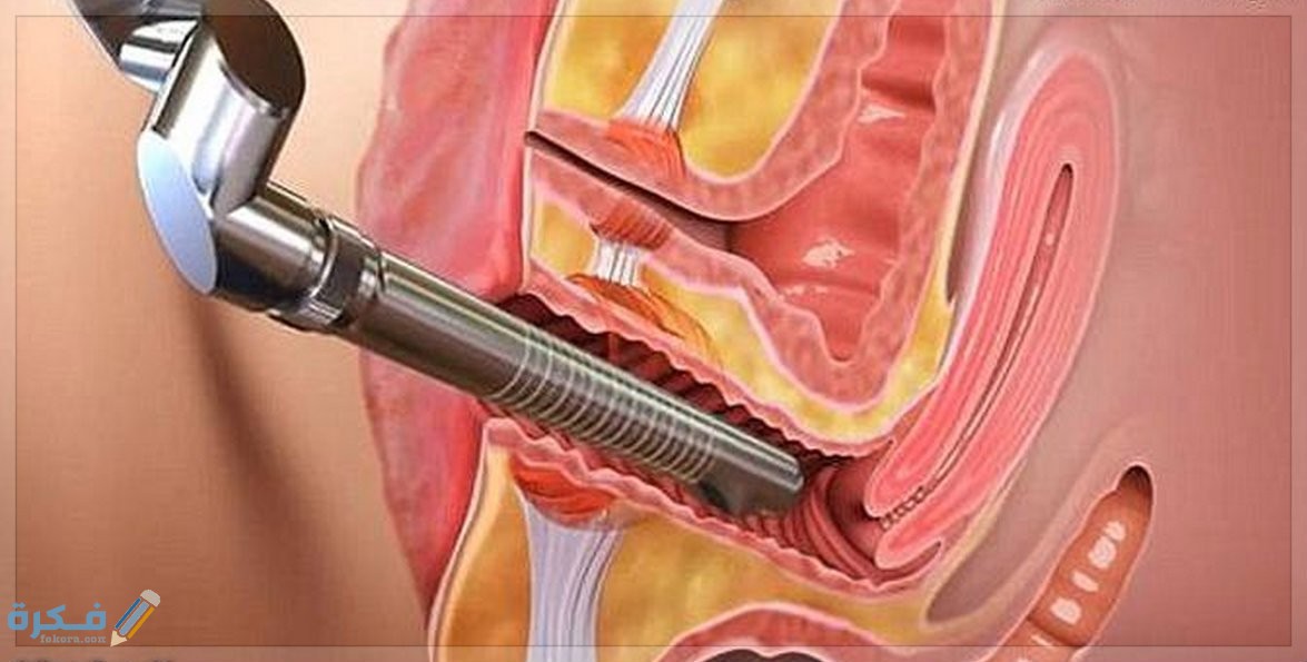 تجربتي مع عملية تضييق المهبل بالليزر 1 BF713B75 40B7 4CE9 B4EE E561EE97E4C0