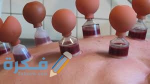 أسماء الأكلات الممنوع بعد الحجامة 1 049D53BF 7786 4DDF BB41 F4535EF27781
