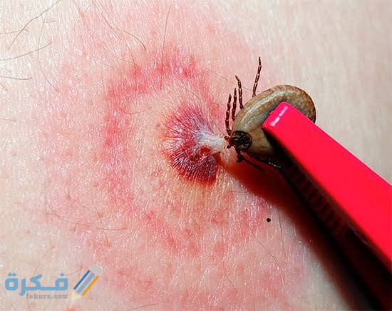 علاج لدغ الحشرات 1 images 2021 11 23T222331.570
