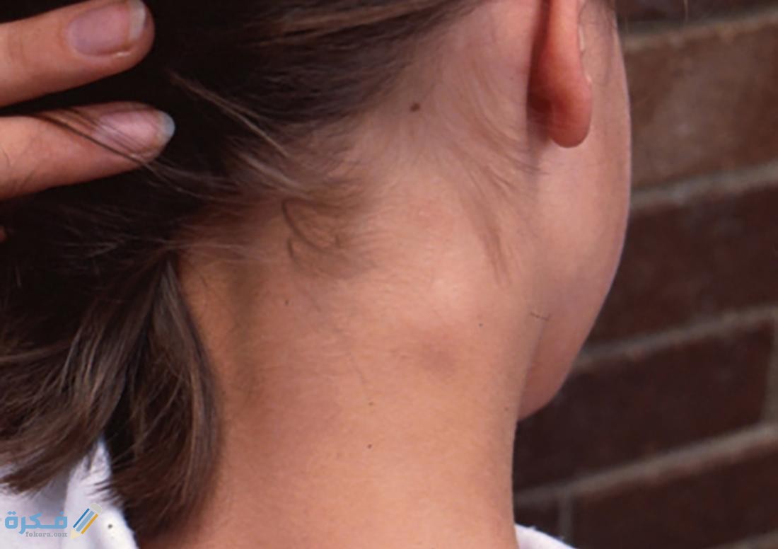 تفسير رؤية ورم في الرقبة في المنام 1 swollen lymph nodes on back of neck image credit hudson bernard 2010