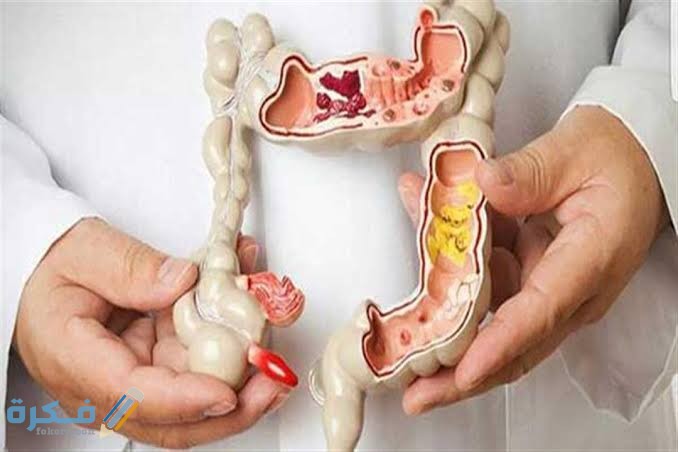 أعراض وعلاج القولون الهضمي عند النساء 1 images 42