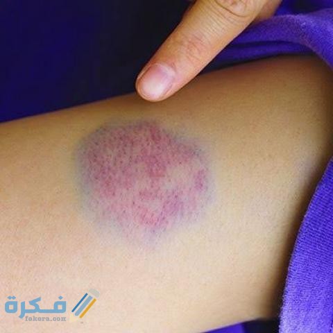 تفسير رؤية الكدمات الخضراء في المنام 1 15957212256438001