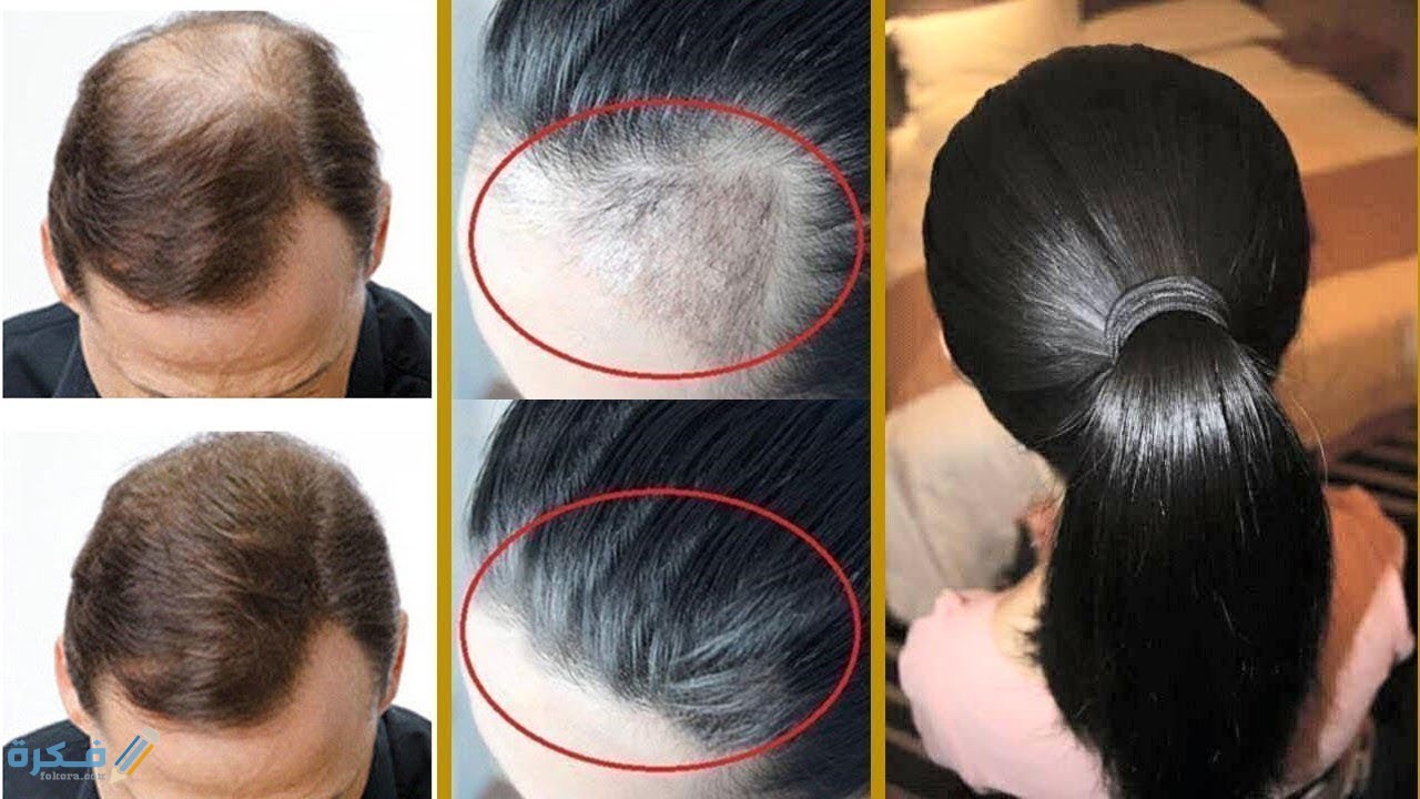 اسماء احسن بخاخ لأنبات الشعر وتكثيفه 1 لانبات الشعر من الامام