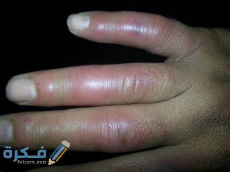 هل يوجد مرهم لعلاج تورم أصابع القدم في الشتاء 1 zjePpLkZIWAYoe3KhROtvgHaFj