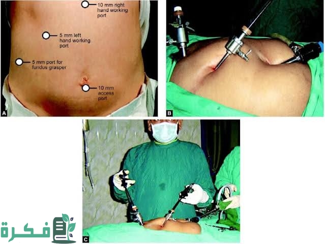 هل عملية المرارة خطيرة وهل يمكن أن تسبب الموت 1 images 2022 07 20T014141.433
