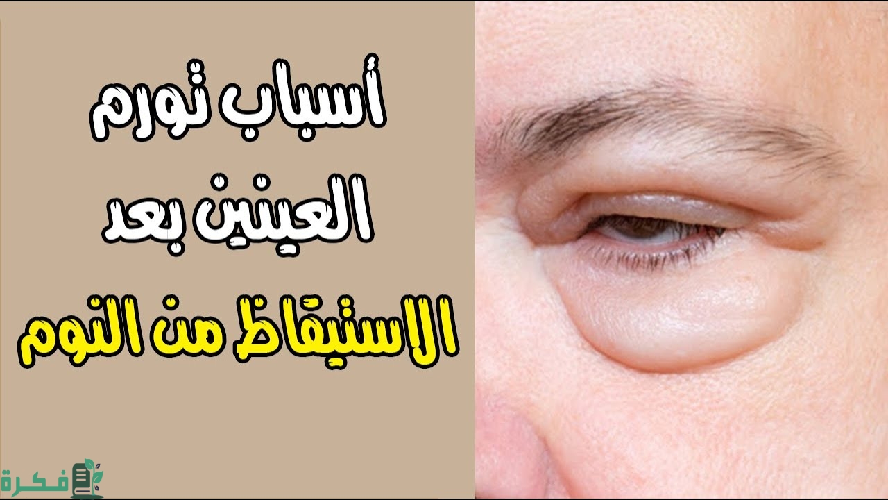 سبب معاناتي من تورم العينين بعد استيقاظي من النوم 1 وسائل طبيعية للحفاظ على صحة العين