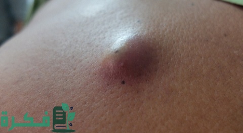 ما سبب ظهور حبة صغيرة تحت الجلد في البطن 1 ما سبب ظهور حبة صغيرة تحت الجلد في البطن