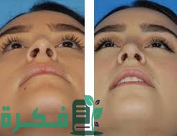 تجربتى مع عملية تجميل الانف 1 5318227E A0E3 421F 8FAF 6E459013A7DE