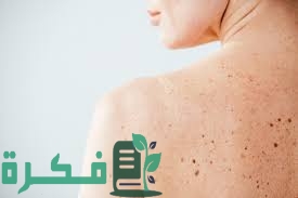 تجربتي مع الكلف العميق 1 5998F792 7AA2 4E2B 8191 54F2E37198B0