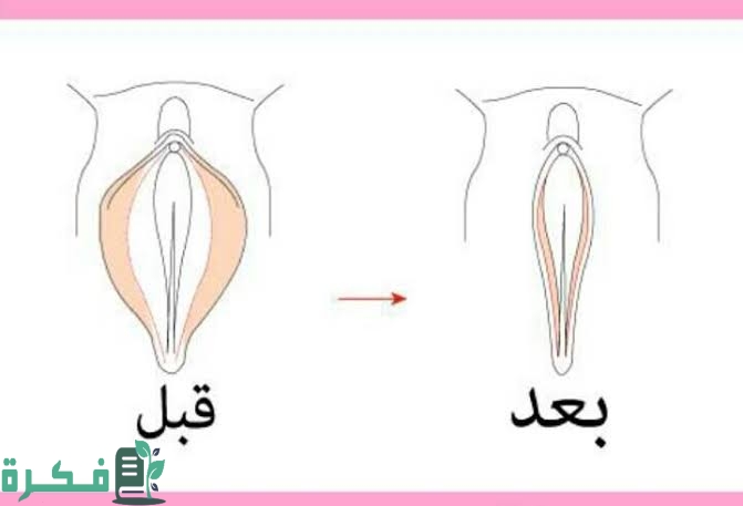 تضييق المهبل بالليزر : كل المعلومات المهمة 1 C664399F 309D 482E A34D 63DE13B5D613