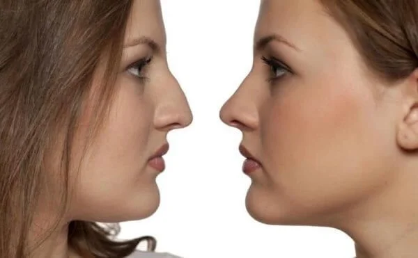 كم تكلفة عملية تجميل الانف في الرياض 1 تكلفة عملية تجميل الانف في الرياض