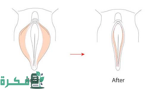 تجربتي مع عملية تجميل الأشفار 1 تجربتي مع عملية تجميل الأشفار