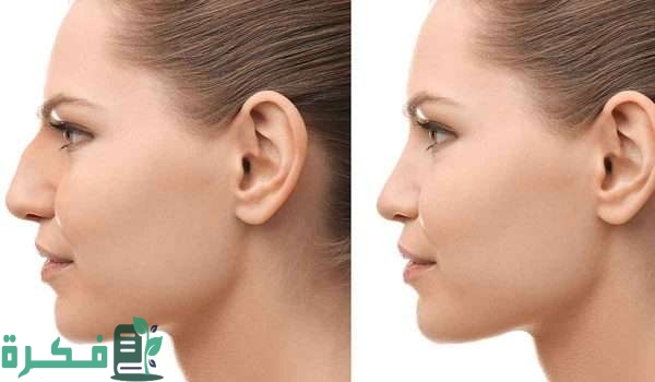 مراحل تغير الأنف بعد عملية التجميل 4 مراحل 1 مراحل تغير الأنف بعد عملية التجميل