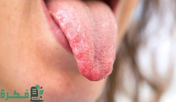أسماء احسن 5 أدوية لعلاج التهاب اللسان 1 أفضل 5 أدوية لعلاج التهاب اللسان