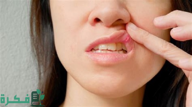 أسماء احسن 5 أنواع مرهم لعلاج قرح الفم 1 أفضل 5 أنواع مرهم لعلاج قرح الفم