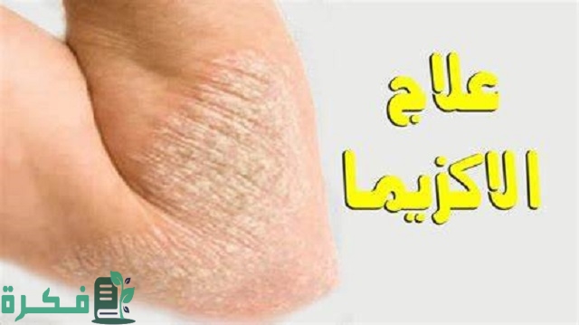 أسماء احسن 5 أنواع كريمات لعلاج الصدفية 1 أفضل 5 أسماء كريمات لعلاج الصدفية
