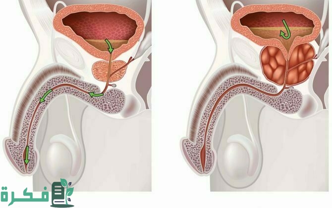 أسماء احسن 5 أدوية علاج تضخم البروستاتا 1 أفضل 5 أدوية علاج تضخم البروستاتا