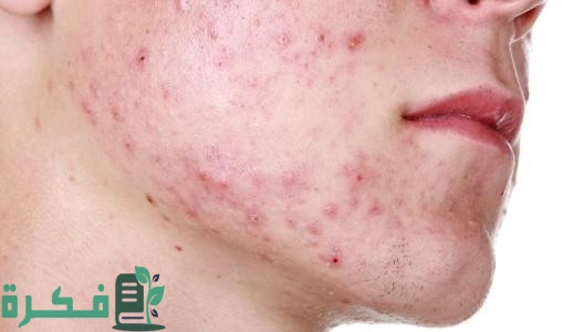 أسماء احسن 5 أدوية علاج حب الشباب للبشرة الدهنية 1 أسماء أفضل 5 أدوية علاج حب الشباب للبشرة الدهنية
